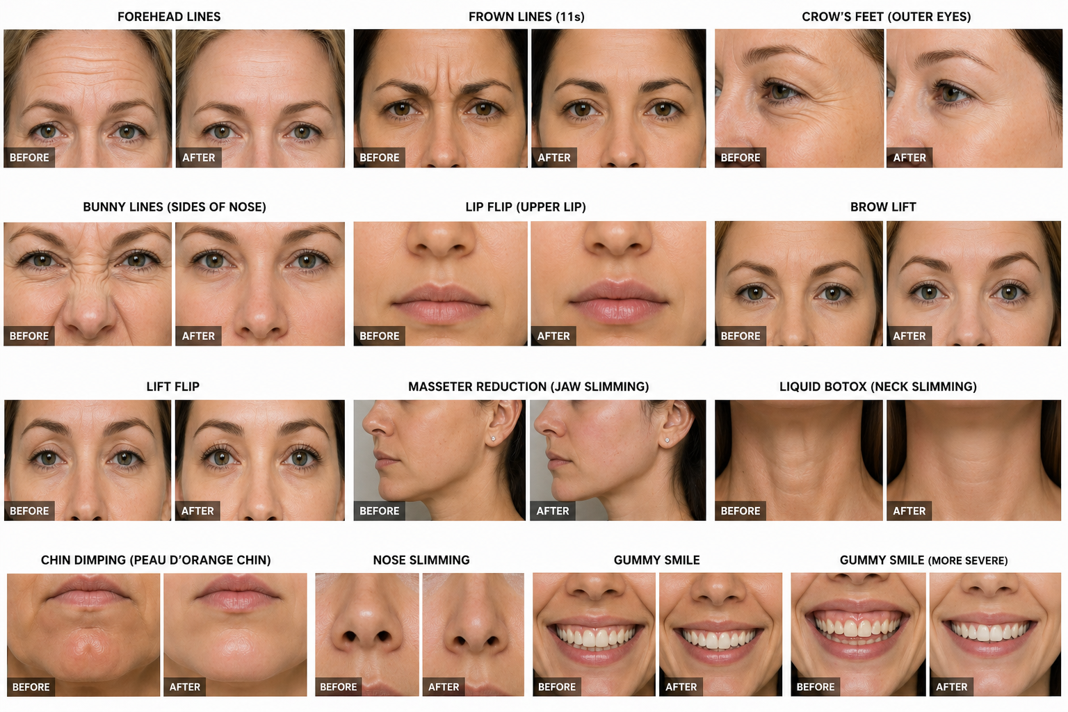 Botox before and after results in Carrollton, TX at St. Mary’s Primary Care & Wellness Center