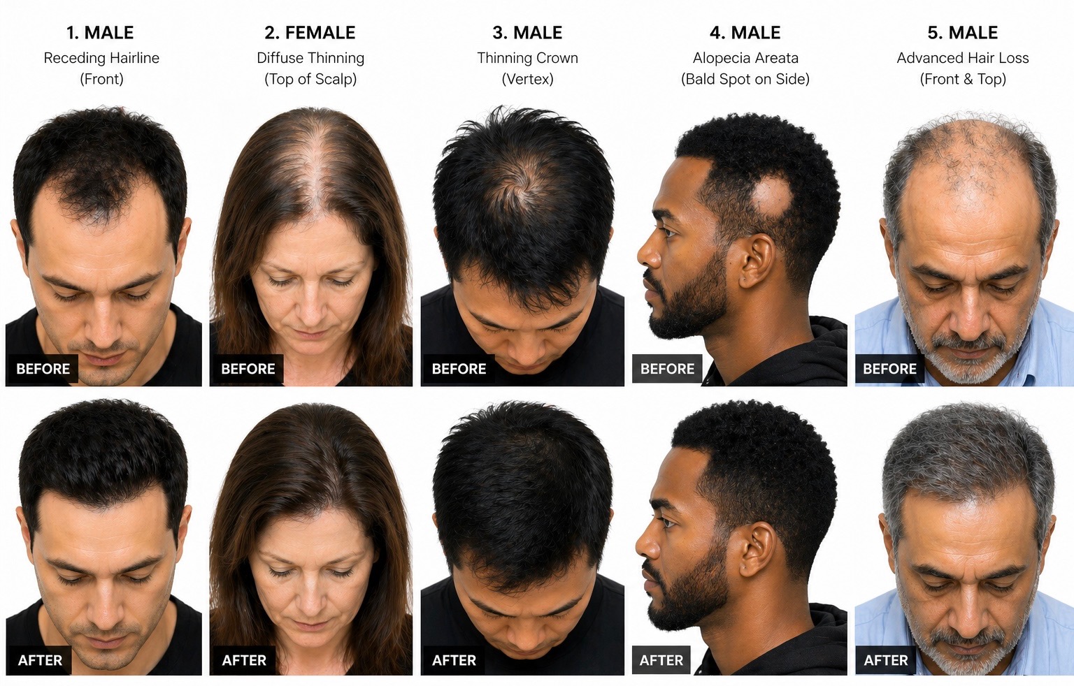 Hair restoration before and after results in Carrollton TX