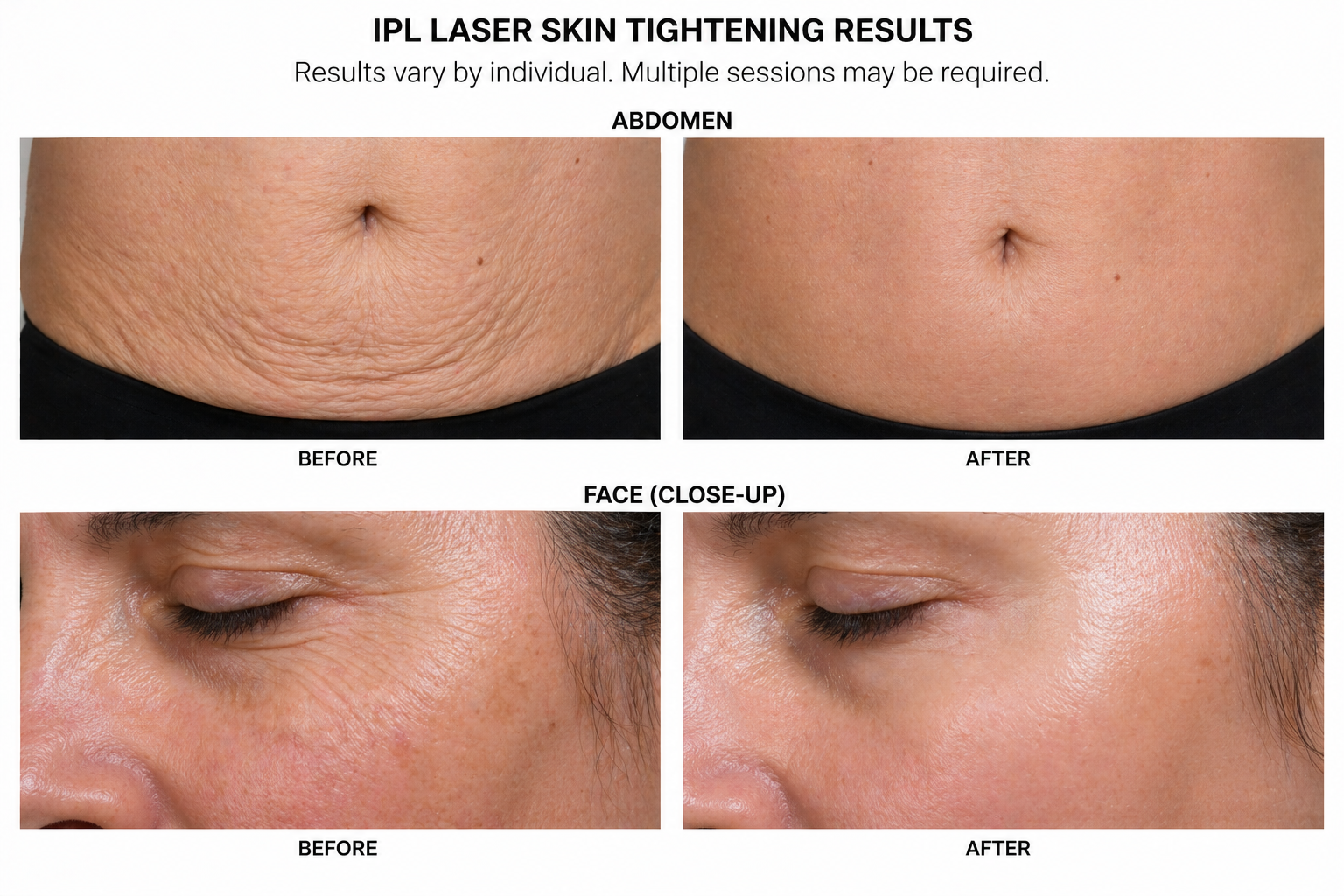 Skin tightening before and after results at St. Mary’s Primary Care & Wellness Center in Carrollton, TX