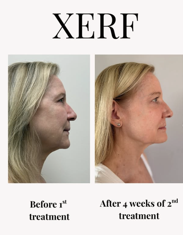 XERF laser skin tightening before and after results in Carrollton TX